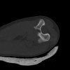 SPORK, NICO - 22.03.1976 - 02.08.2022 - CT obere Extremität - 18:02:23